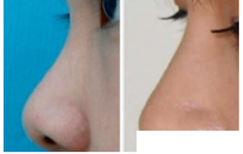 韩国尚美佳整形医院隆鼻手术案例