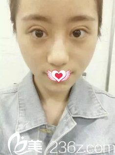 刚做完双眼皮手术眼睛肿胀 刚做完双眼皮手术眼睛肿胀