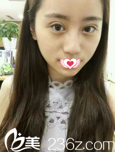 术后7天双眼皮拆线后的样子 术后7天双眼皮拆线后的样子