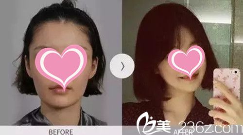 韩国尚美佳整形外科医院院长金成南面部轮廓整形手术案例分享