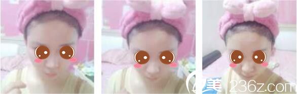 韩国延世毛百丽植发中心杨泫准毛发移植真人案例术后第七天