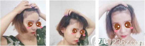 韩国延世毛百丽植发中心杨泫准毛发移植真人案例术后二十一天