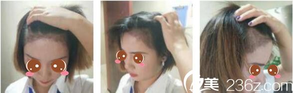 韩国延世毛百丽植发中心杨泫准毛发移植真人案例术后一个月