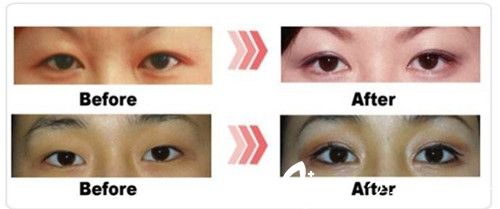 李武永院长双眼皮手术案例分享 李武永院长双眼皮手术案例分享