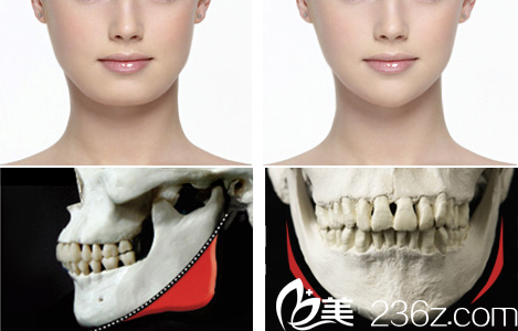 面部轮廓手术前后对比