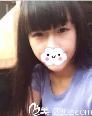 双眼皮手术前照片 双眼皮手术前照片