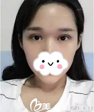 术后3天 术后3天