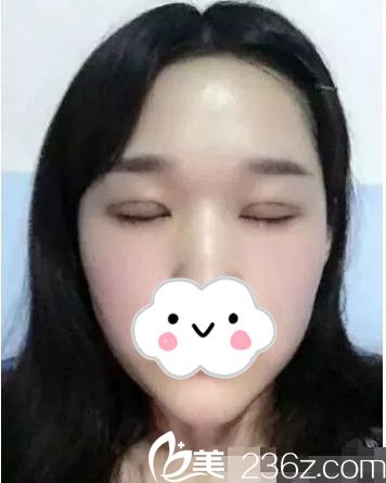 双眼皮拆线了 双眼皮拆线了