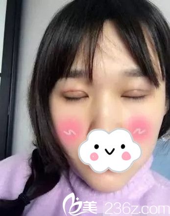 李武永双眼皮手术案例分享 李武永双眼皮手术案例分享
