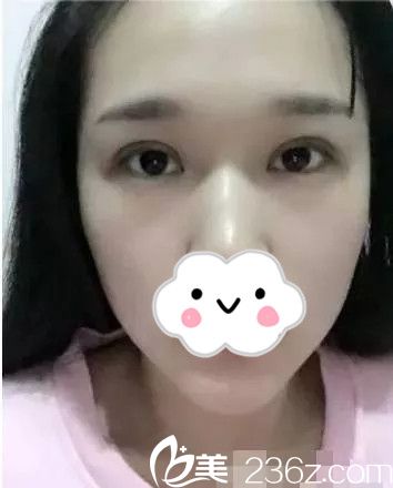 双眼皮术后15天效果 双眼皮术后15天效果