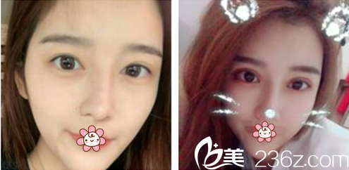 金均泰院长双眼皮修复案例 金均泰院长双眼皮修复案例