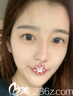 之前做的那个双眼皮 之前做的那个双眼皮