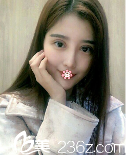 金均泰双眼皮修复术后一周 金均泰双眼皮修复术后一周