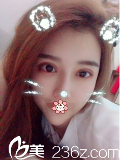 韩国NYPS整形外科双眼皮修复术后23天 韩国NYPS整形外科双眼皮修复术后23天