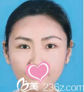 在郑州美贝做的双眼皮+自体脂肪面部填充 老公把我的照片设置成电脑壁纸