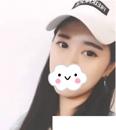 趁着去韩国旅游找伍人整形医院魏成润做了双眼皮，真的很值