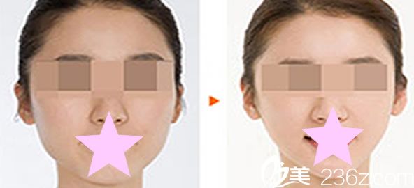 郑州医德佳整形美容胡斌院长微创玻尿酸瘦脸案例 郑州医德佳整形美容胡斌院长微创玻尿酸瘦脸案例