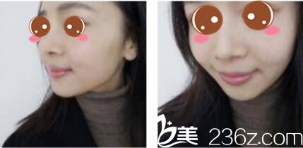 上海华美医疗美容医院常春注射真人案例术后第七天