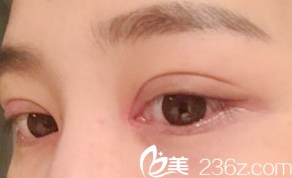 南阳全切双眼皮