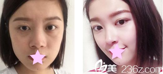 兰州亚韩整形鼻综合隆鼻+去眼袋前后效果对比