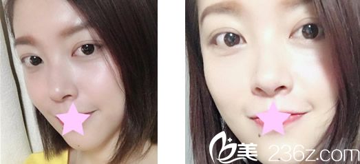 综合隆鼻一个月后的恢复效果