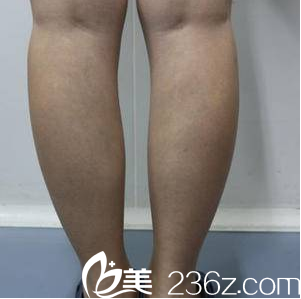 在北京美莱做共振吸脂前样子 在北京美莱做共振吸脂前样子