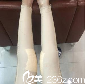 北京美莱共振吸脂第8天效果 北京美莱共振吸脂第8天效果