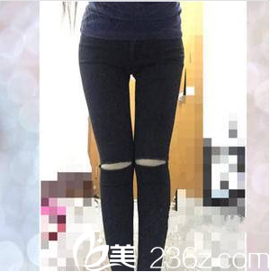 北京美莱黄杰共振吸脂案例第35天效果 北京美莱黄杰共振吸脂案例第35天效果