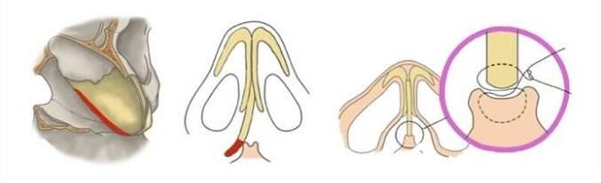 韩国尹熙根整形外科隆鼻手术方法 韩国尹熙根整形外科隆鼻手术方法