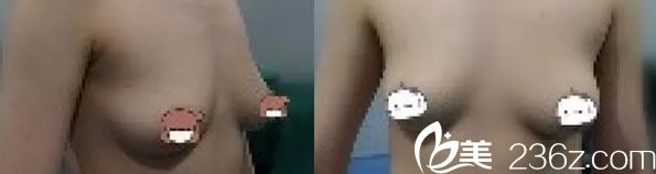 崔平林医生自体脂肪隆胸案例前