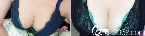 韩国艺雅特整形医院自体脂肪隆胸三个月后效果图