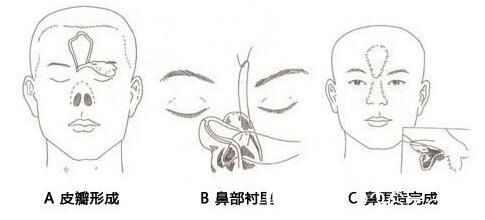 韩国尹熙根整形外科尹熙根鼻再造术 韩国尹熙根整形外科尹熙根鼻再造术