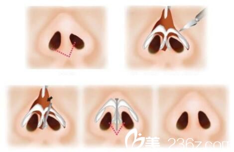 韩国尹熙根整形外科尹熙根鼻再造 韩国尹熙根整形外科尹熙根鼻再造