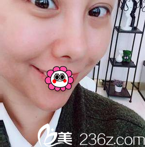 在北京美莱做埋线双眼皮鼻综合第8天效果