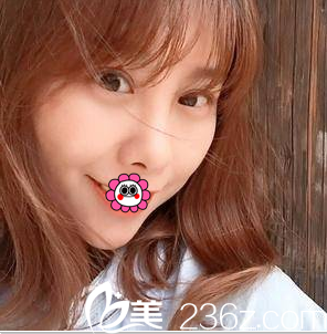 北京美莱埋线双眼皮鼻综合案例