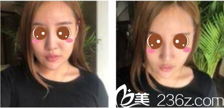 韩国尹熙根整形外科尹熙根假体隆鼻真人案例术前照 韩国尹熙根整形外科尹熙根假体隆鼻真人案例术前照