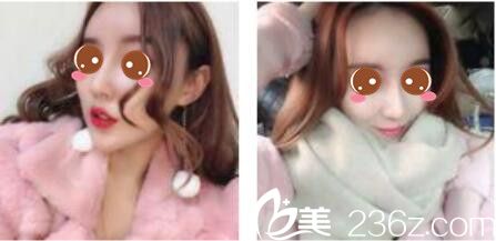 韩国尹熙根整形外科尹熙根假体隆鼻真人案例术后一个月 韩国尹熙根整形外科尹熙根假体隆鼻真人案例术后一个月