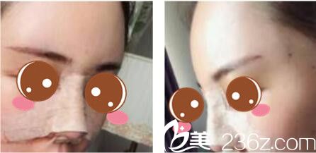 韩国尹熙根整形外科尹熙根假体隆鼻真人案例术后第三天 韩国尹熙根整形外科尹熙根假体隆鼻真人案例术后第三天