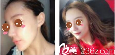 韩国尹熙根整形外科尹熙根假体隆鼻真人案例术后两个月 韩国尹熙根整形外科尹熙根假体隆鼻真人案例术后两个月