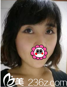 在北京美莱玻尿酸丰卧蚕注射瘦脸前样子 在北京美莱玻尿酸丰卧蚕注射瘦脸前样子