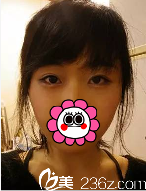 在北京美莱做玻尿酸丰卧蚕注射瘦脸第2天样子 在北京美莱做玻尿酸丰卧蚕注射瘦脸第2天样子