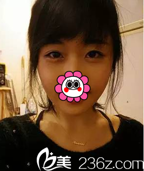 找周福田做玻尿酸丰卧蚕注射瘦脸第5天 找周福田做玻尿酸丰卧蚕注射瘦脸第5天