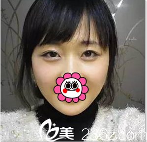 北京美莱玻尿酸丰卧蚕注射瘦脸案例 北京美莱玻尿酸丰卧蚕注射瘦脸案例