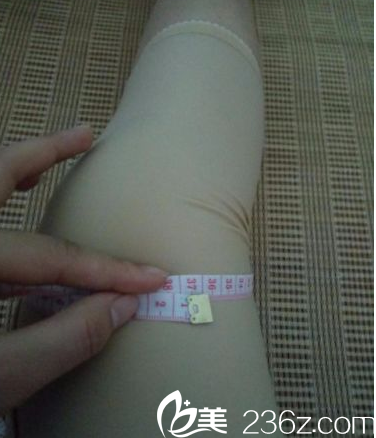 在北京知音做水动力腿部吸脂第8天 在北京知音做水动力腿部吸脂第8天