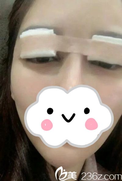 双眼皮手术修复后第1天
