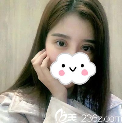 安恩模院长给我做双眼皮修复手术6天了