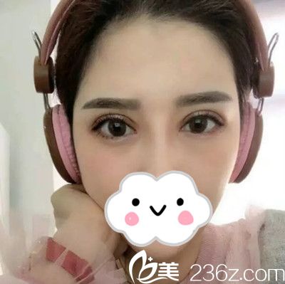 双眼皮修复14天后恢复情况