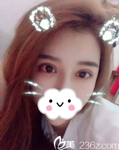 韩国美作整形医院双眼皮修复手术案例