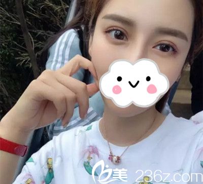 双眼皮修复一个月后