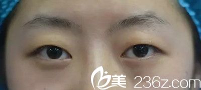 双眼皮手术前照片 双眼皮手术前照片